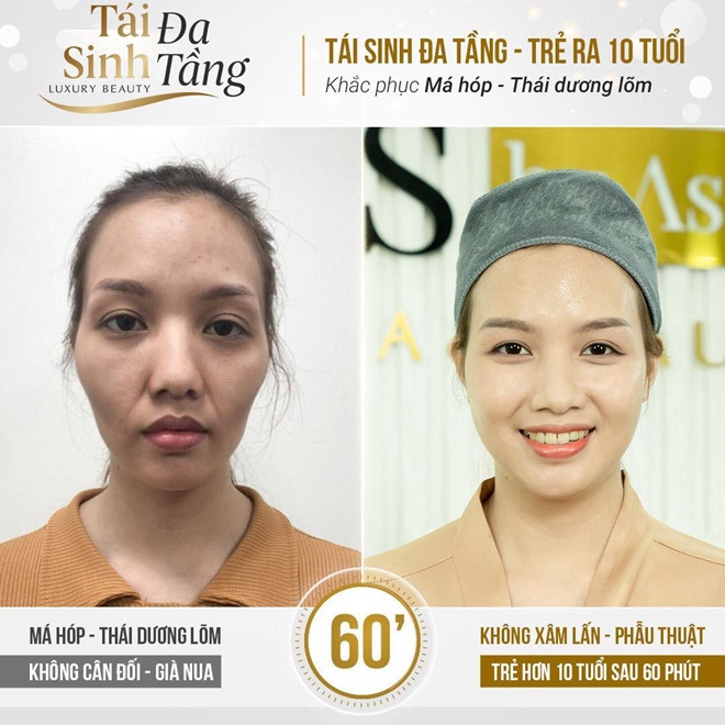 Công nghệ giúp trẻ hóa khuôn mặt đã giúp giám đốc Hoa thoát mặc cảm mặt hốc hác già trước tuổi
