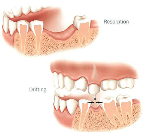 Mất răng lâu ngày gây ra nhiều tác hại khác nhau