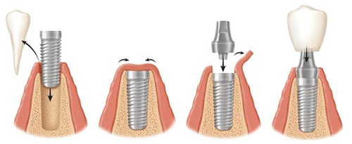 Mất răng lâu ngày gây ra nhiều tác hại khác nhau, Nên tiến hành làm Implant cùng lúc ngay khi nhổ răng