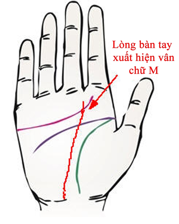 Lòng bàn tay xuất hiện vân chữ M