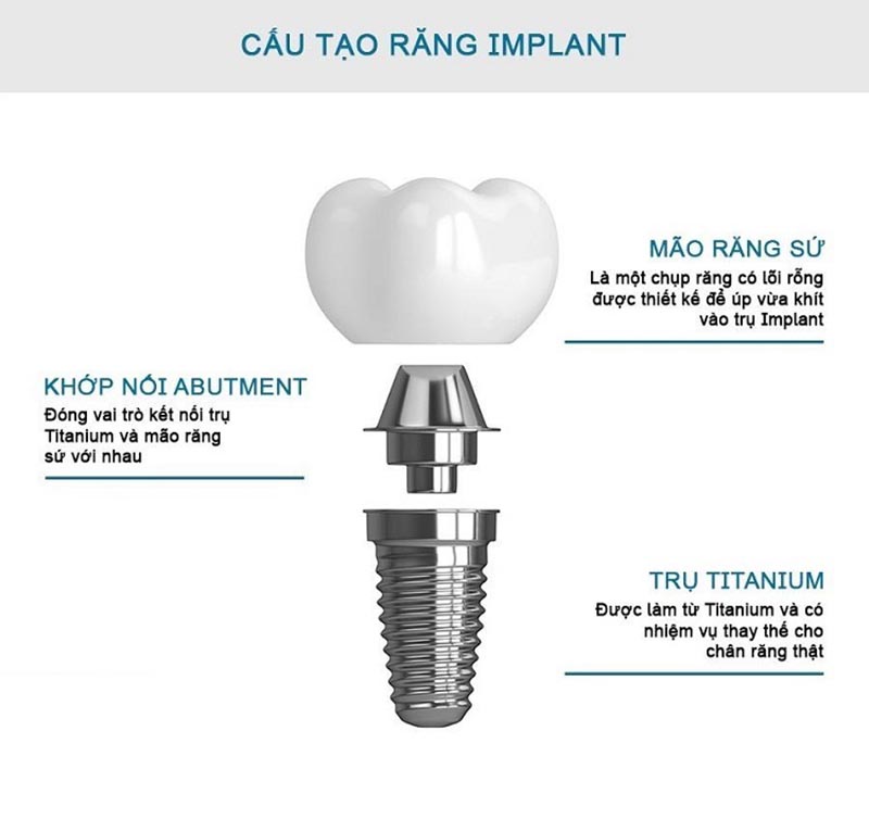 Kỹ thuật Implant giúp phục hồi chức năng và thẩm mỹ của răng